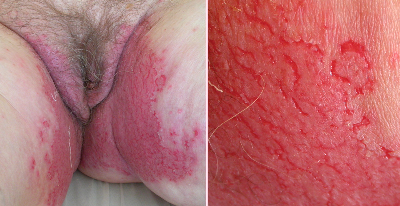 Vulvar Contact Dermatitis