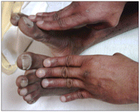 cyanotic toes