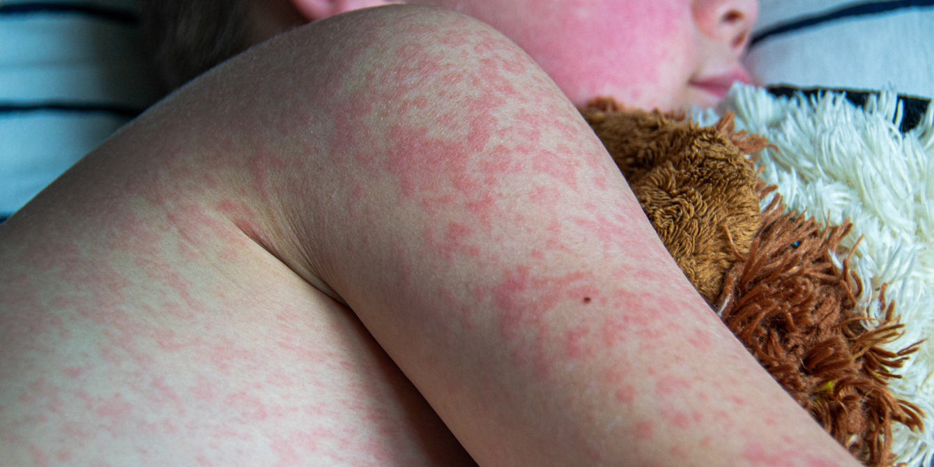 Measles rash on the body of the child.