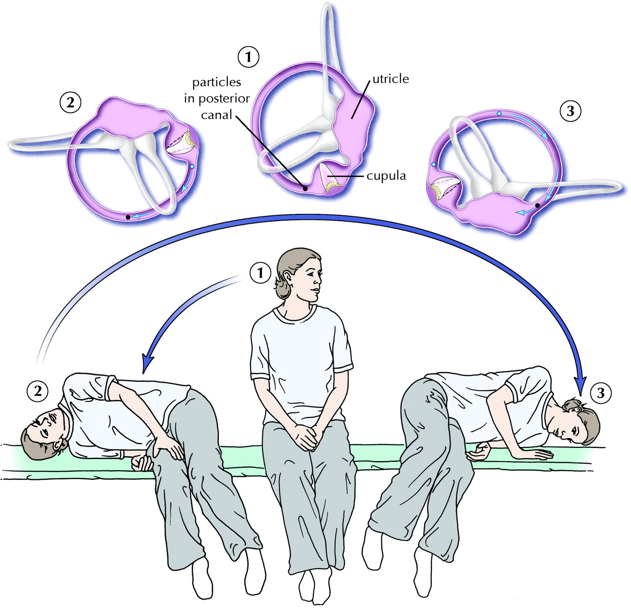 chiropractic technique for vertigo epley maneuver
