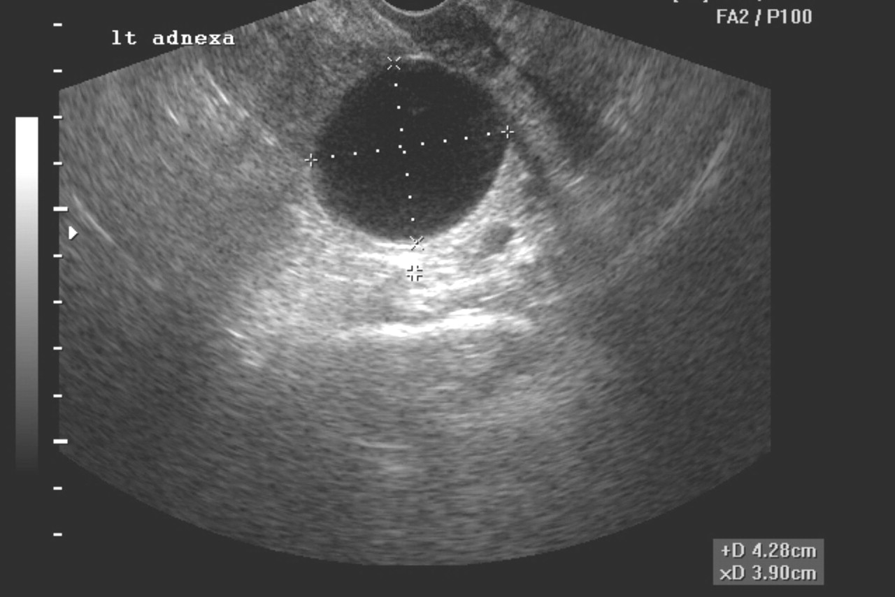 simple ovarian cyst ultrasound