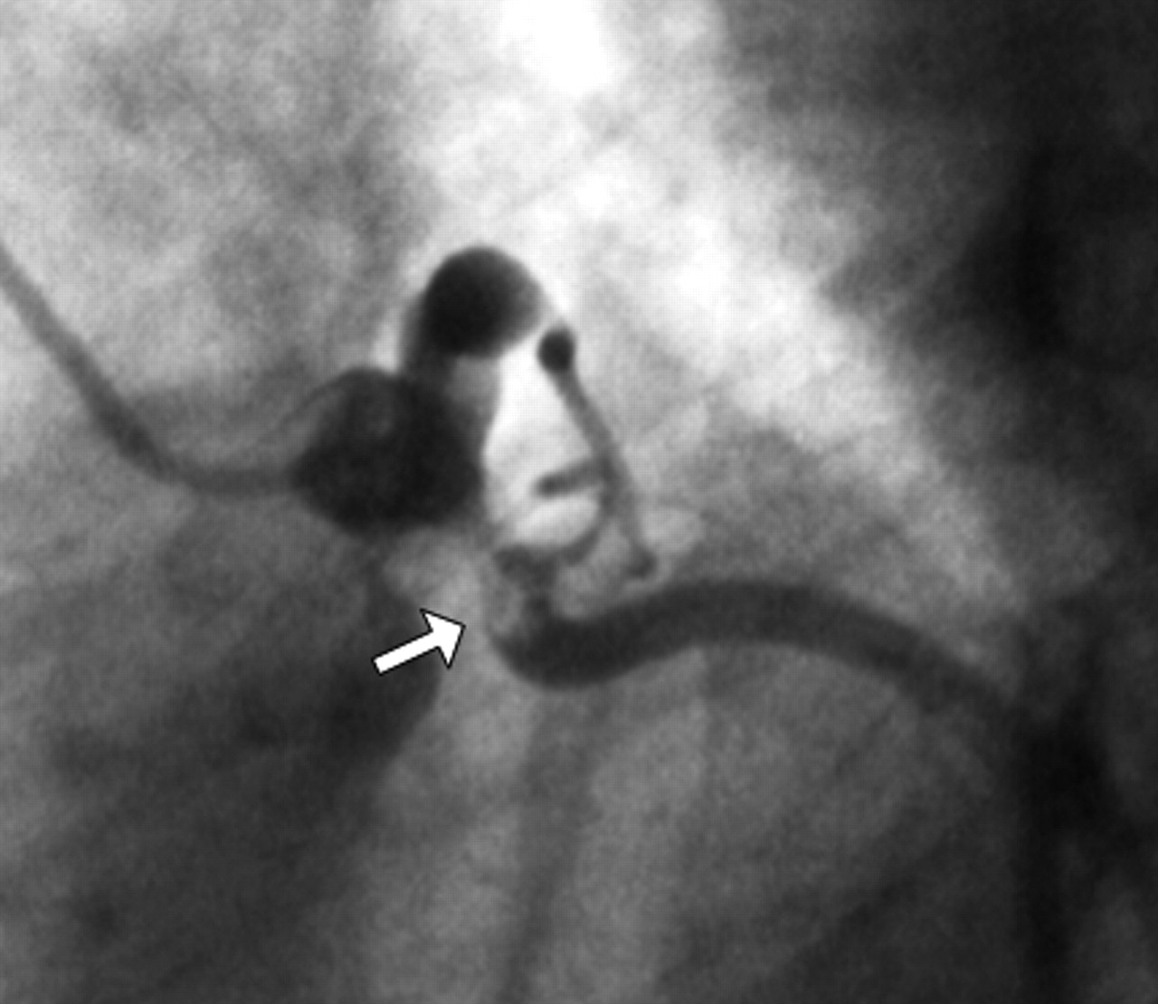 Velsigne Blot Slutning A case of myocardial infarction complicating Kawasaki disease | CMAJ