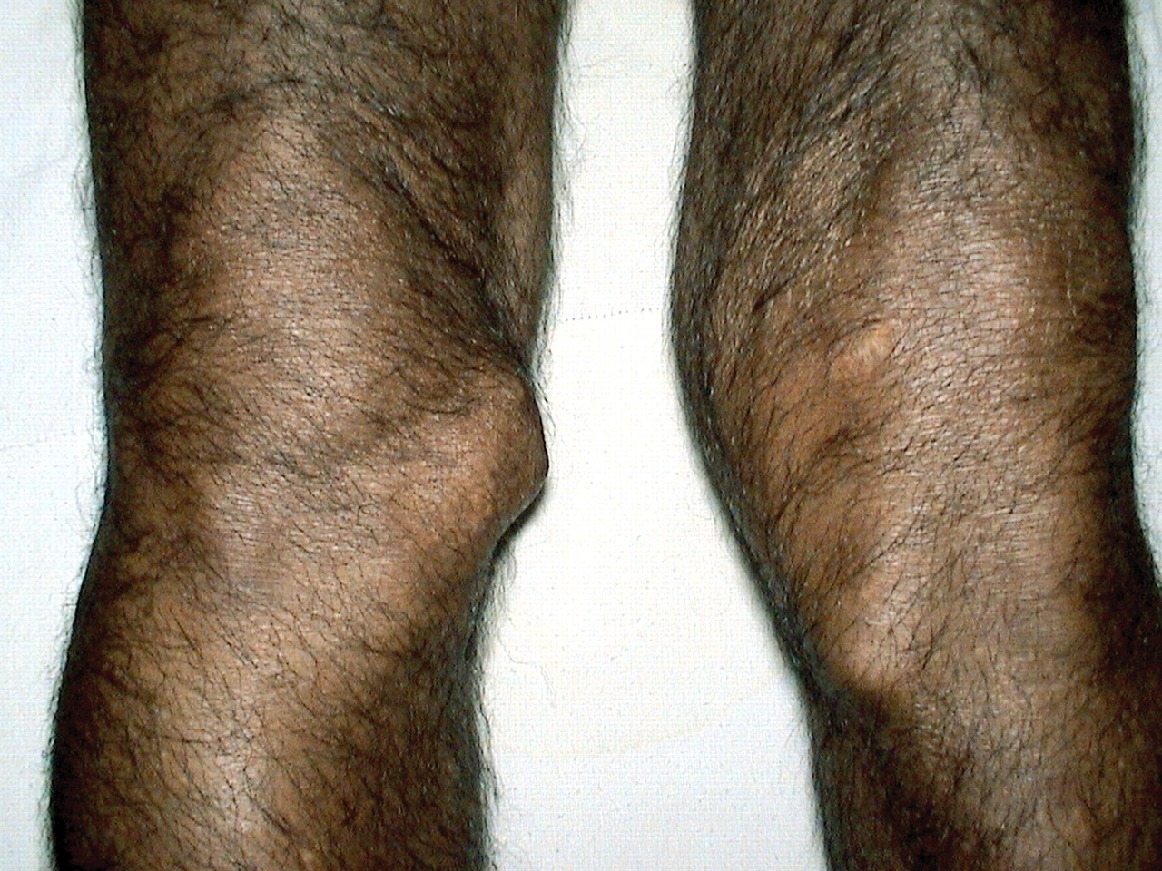 bony knees
