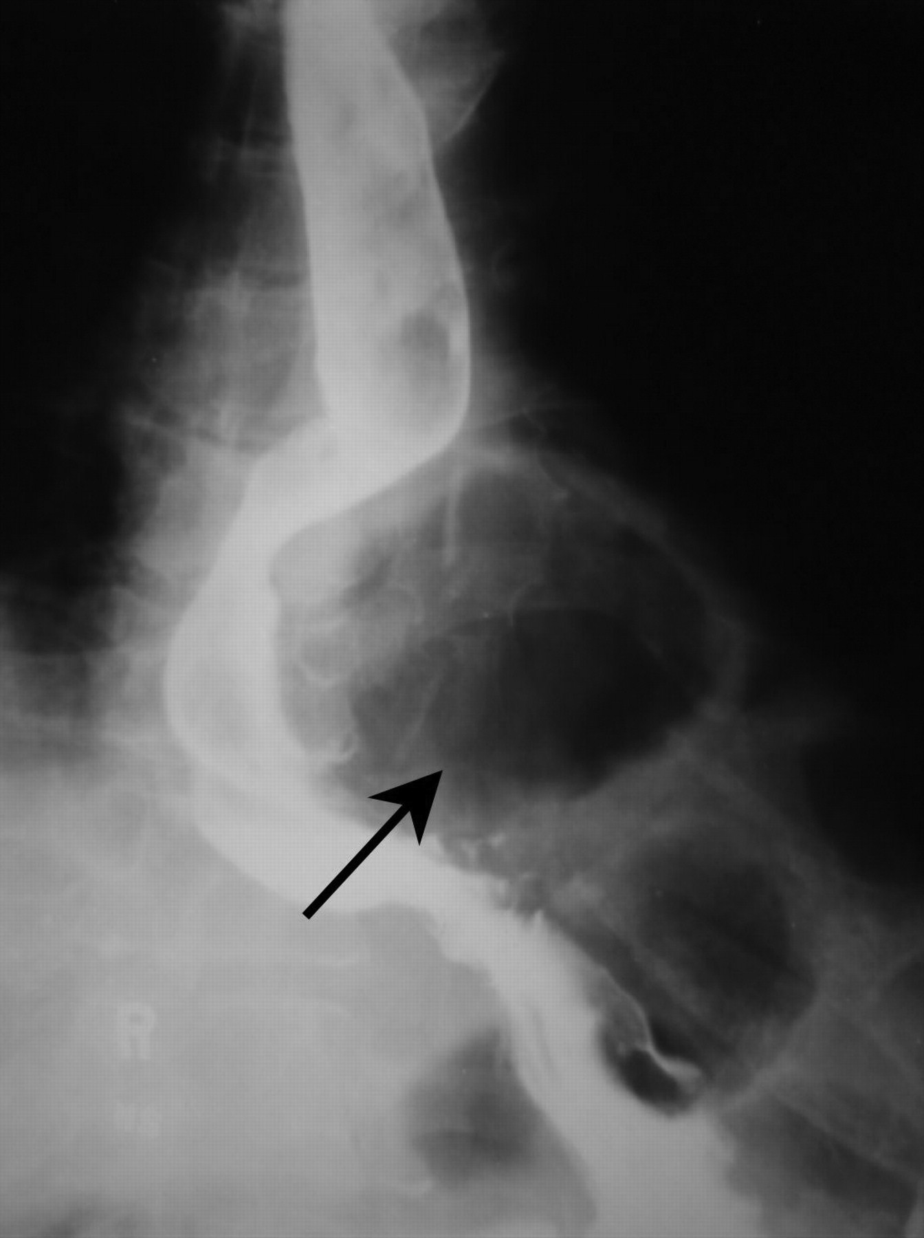 Paraesophageal Hernia Barium Swallow
