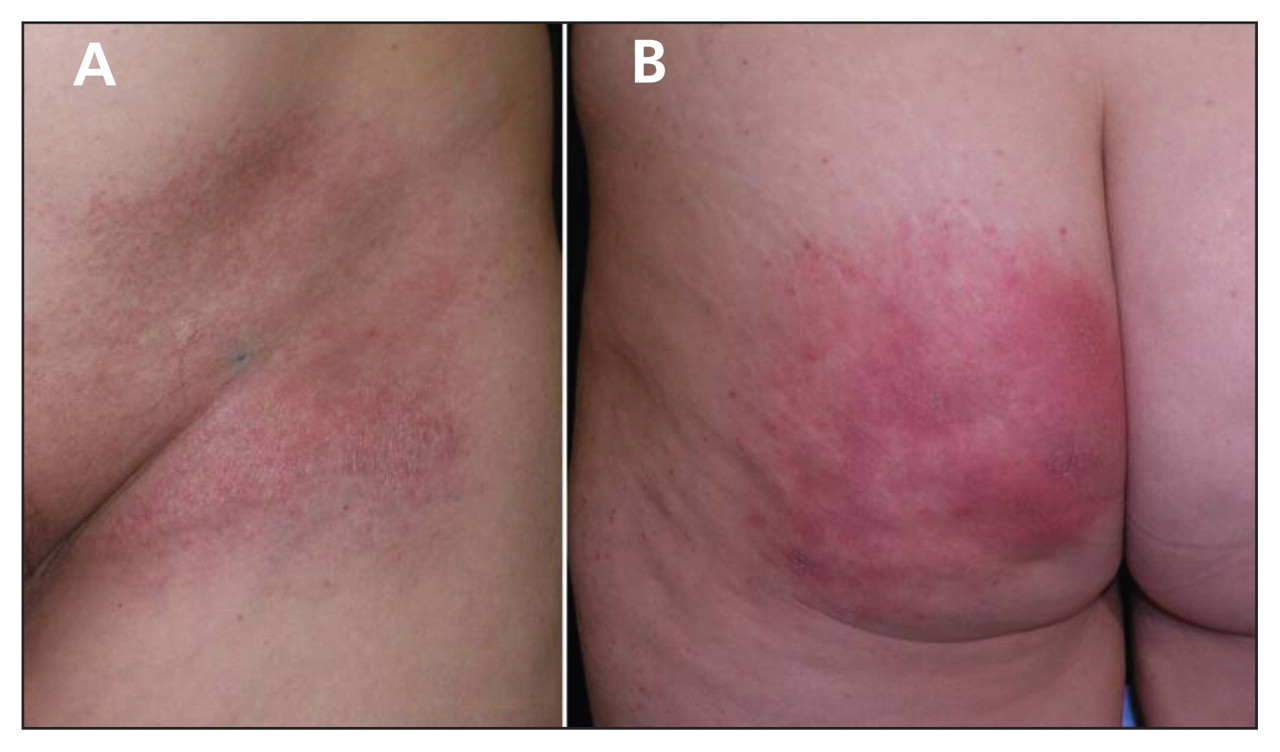 Radiation Recall Dermatitis Triggered by Prednisone