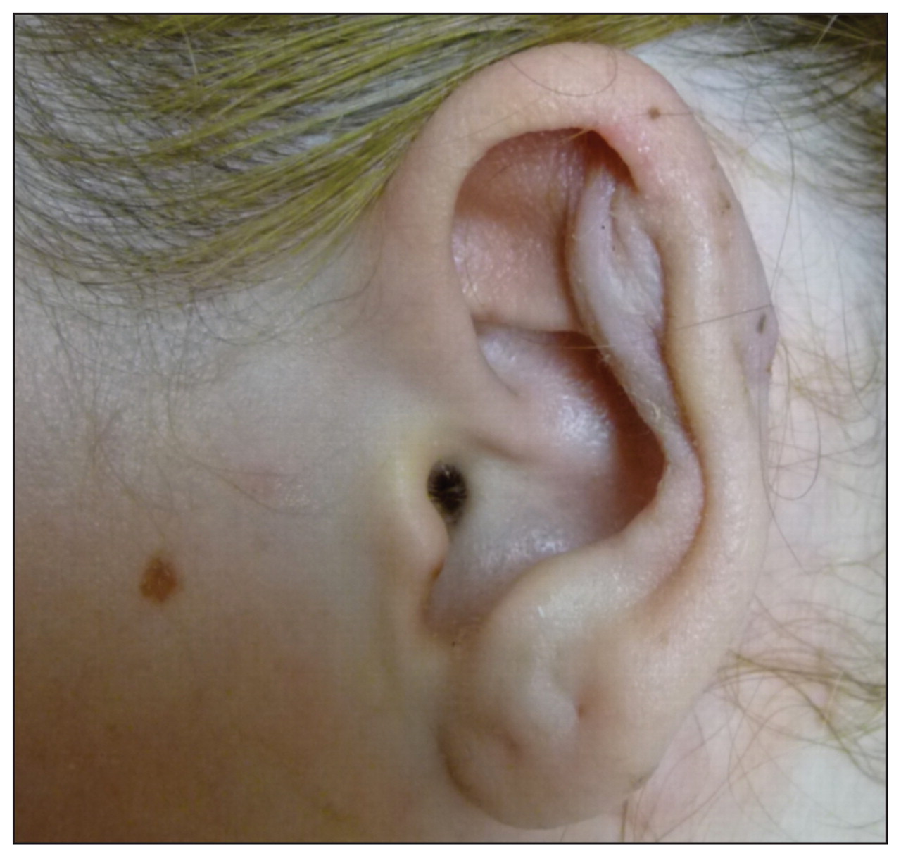 Necrotizing Pseudomonas Chondritis After Piercing Of The Upper Ear Cmaj