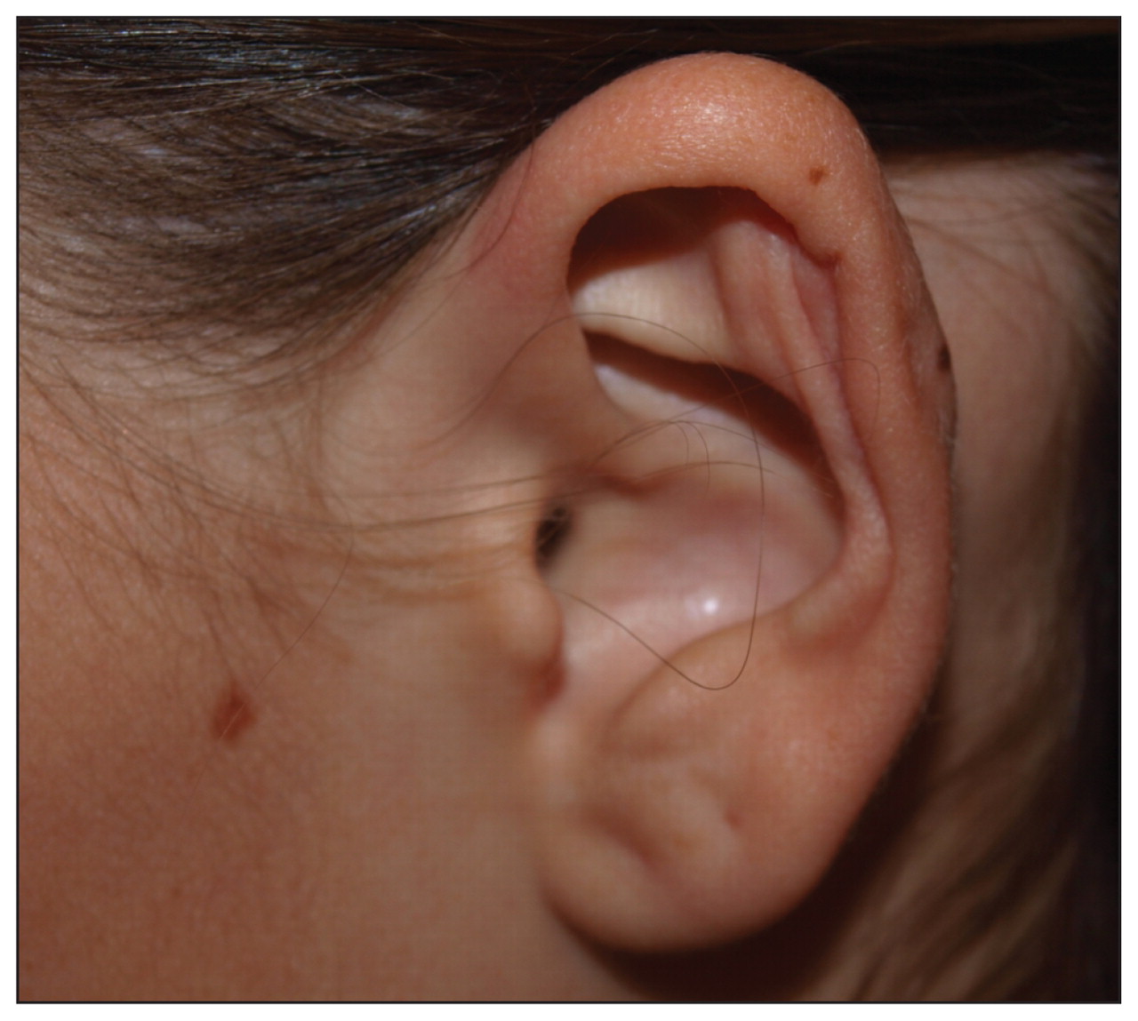 pseudomonas aeruginosa ear infection