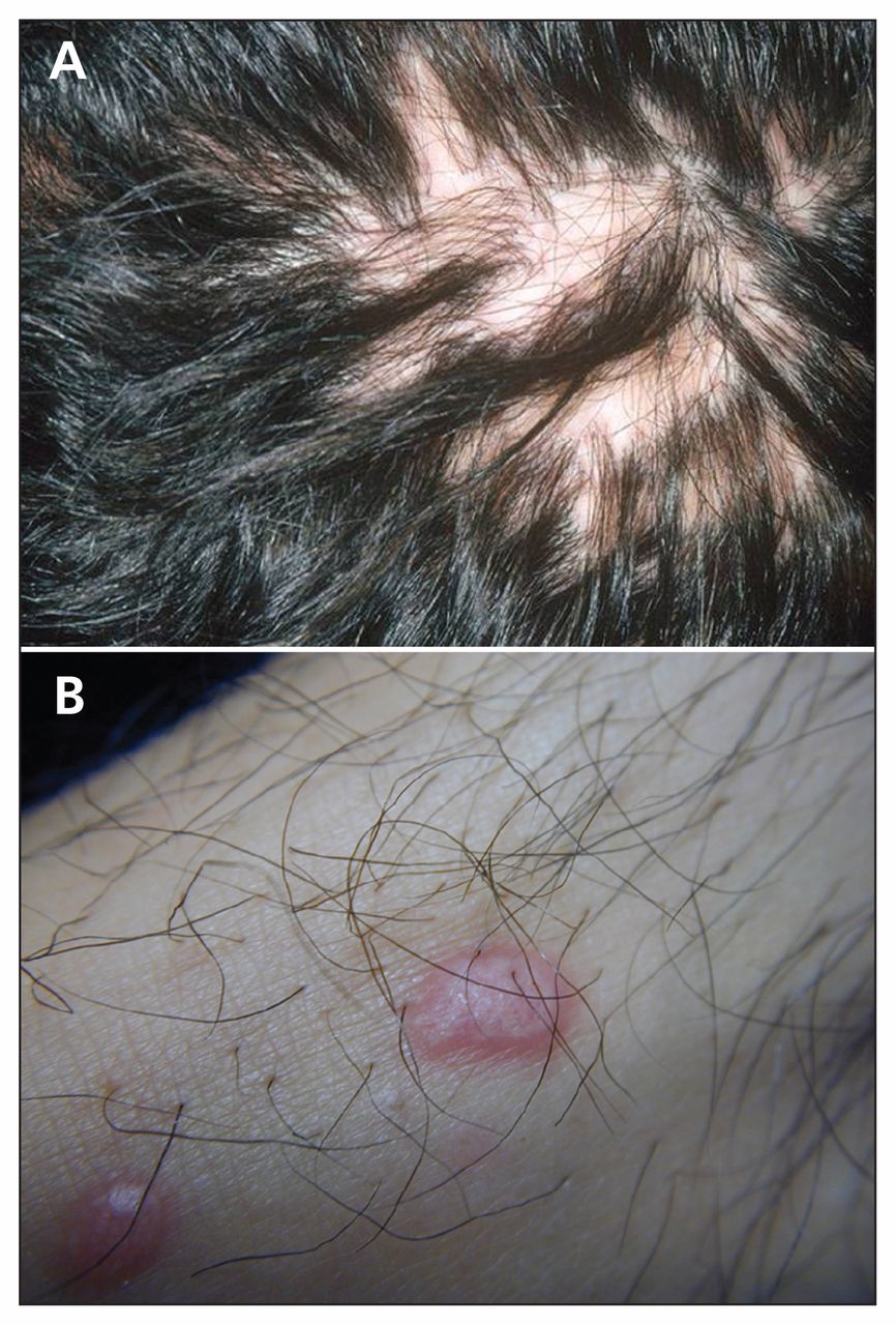 follicular hyperkeratosis scalp