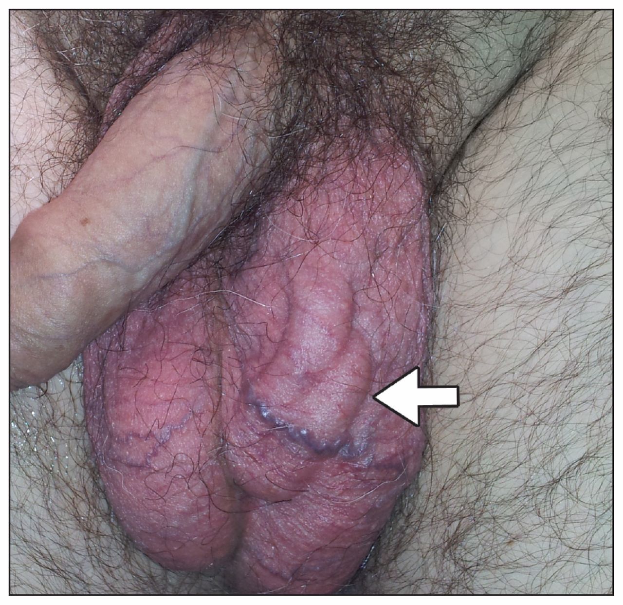 варикоз на груди у мужчин фото 28