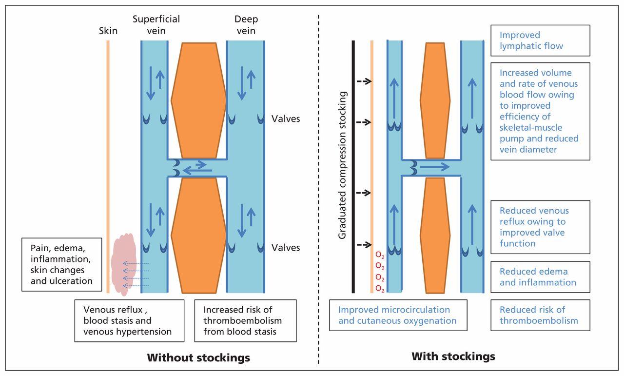 Use and application of graduated elastic compression stockings