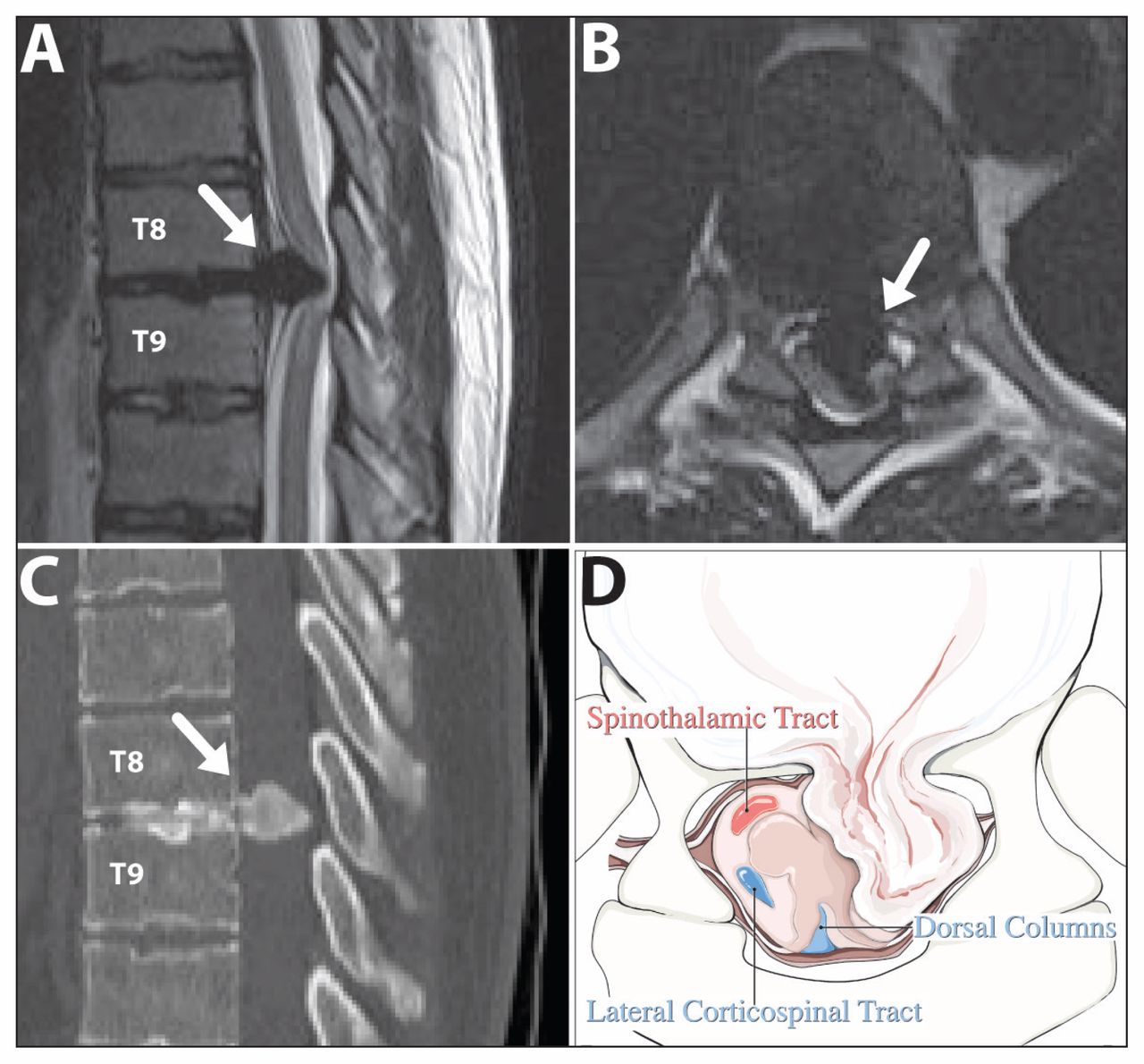 Herniated disc of the thoracic spine