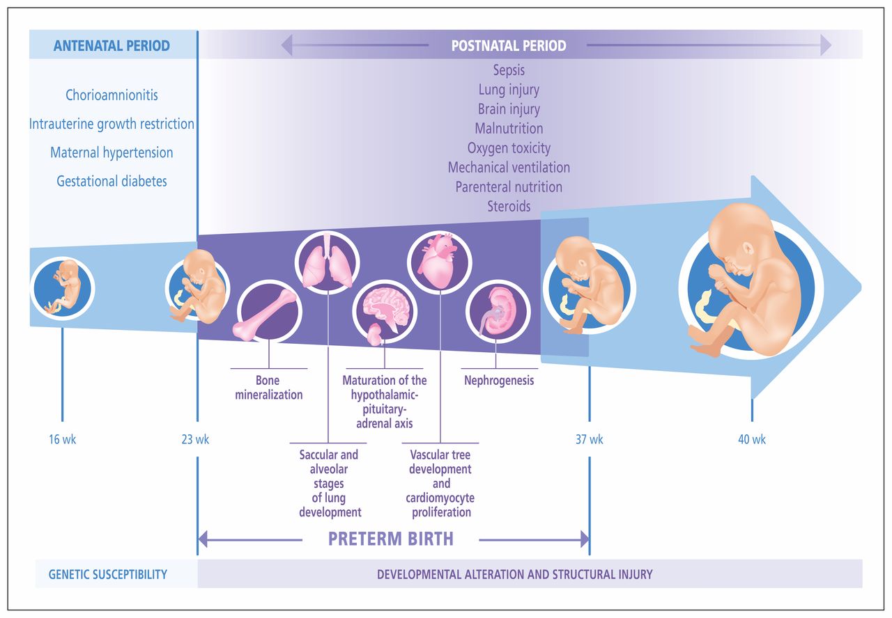 Preterm birth risk factor for earlyonset chronic diseases CMAJ