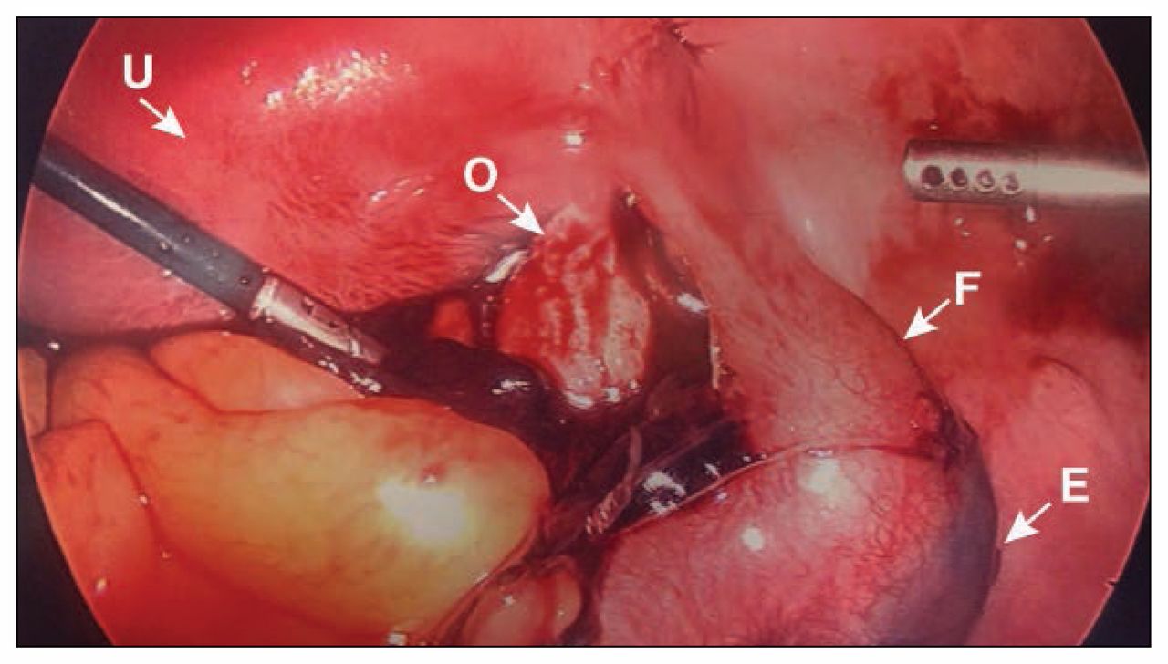 Laparoscopic view. (A) Previously ruptured contents of the right