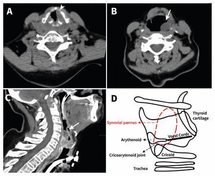 Laryngeal stridor in rheumatoid arthritis | CMAJ