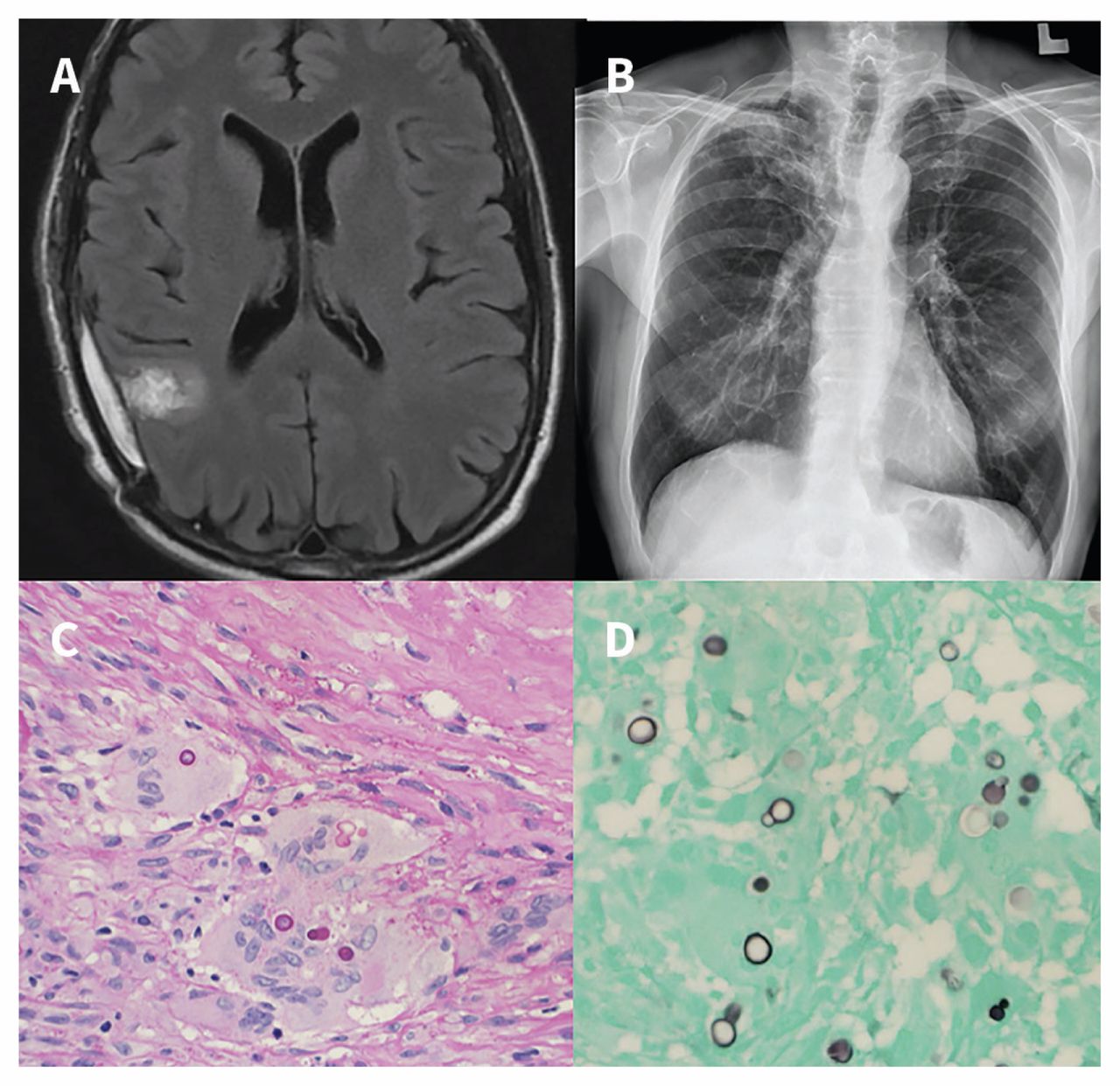 Disseminated Blastomycosis In A 57 Year Old Man Working In Construction Cmaj