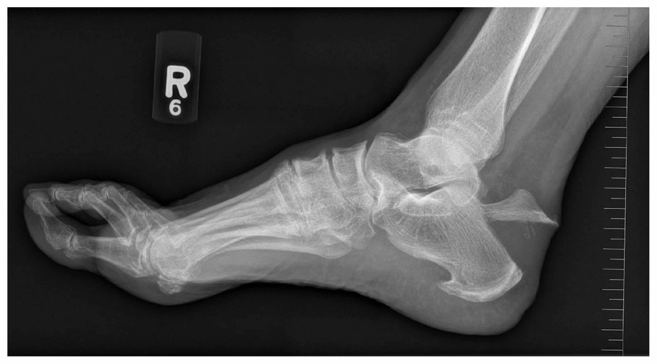 broken heel x ray
