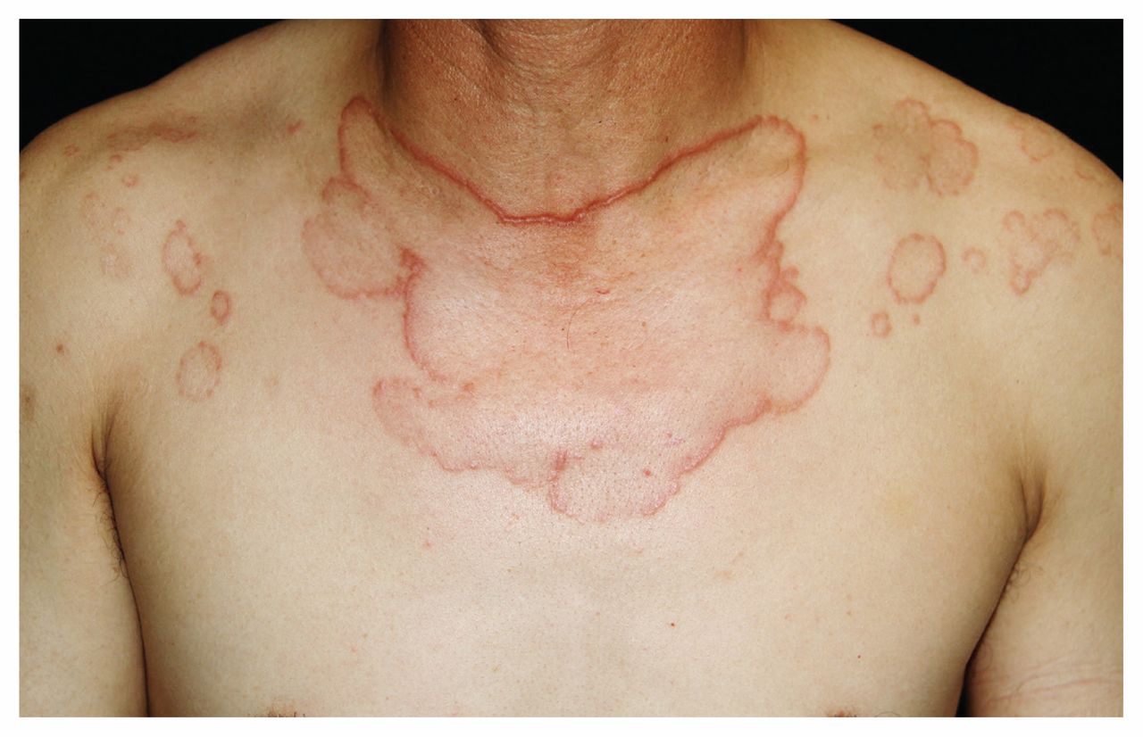 Sarcoidosis Appearing in a Tattoo - Saba M. Ali, Anita C. Gilliam, Robert  T. Brodell, 2008