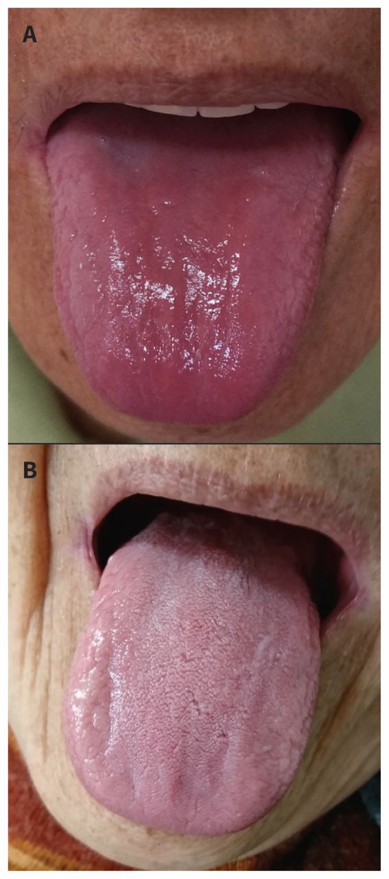 vitamin b deficiency tongue