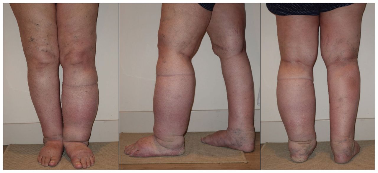 Managing Lymphedema With Complete Decongestive Therapy