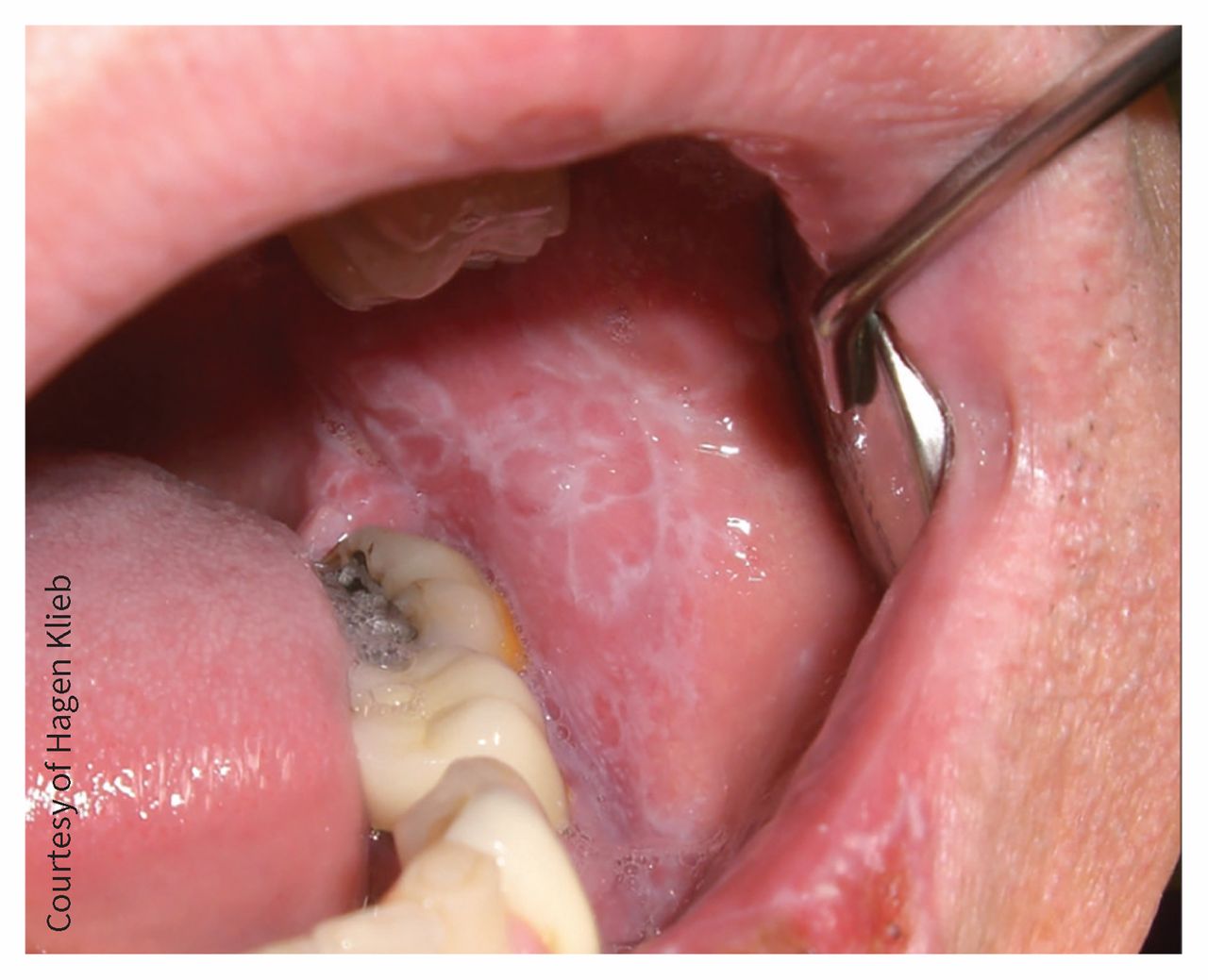 reticular oral lichen planus