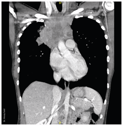 Computed tomography of the author's chest, showing a 10 cm × 7 cm × 10 cm mediastinal mass with severe compression of the superior vena cava.