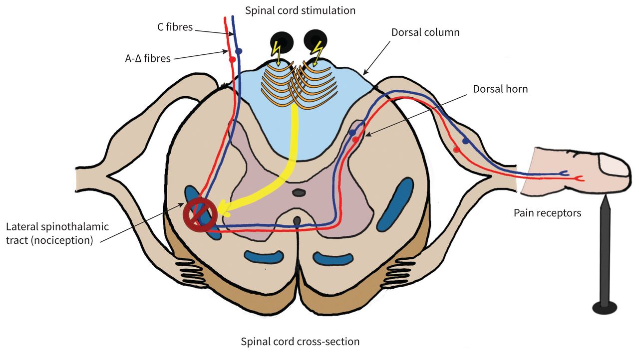 Frontiers  Epidural Electrical Stimulation: A Review of