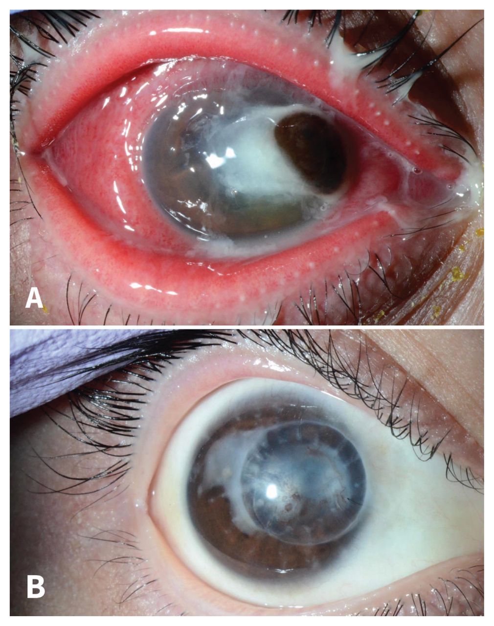 Risk factors, clinical features and outcomes of Neisseria keratitis