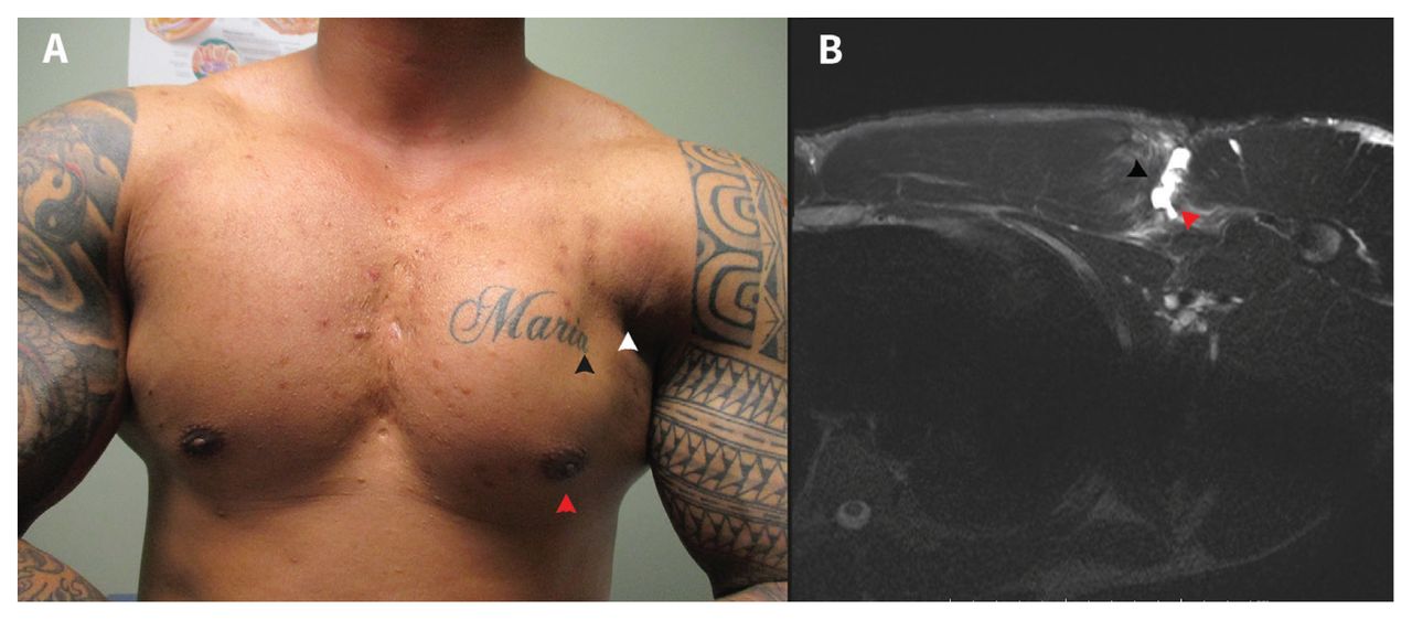 Chronic pectoralis major rupture in a 32-year-old man