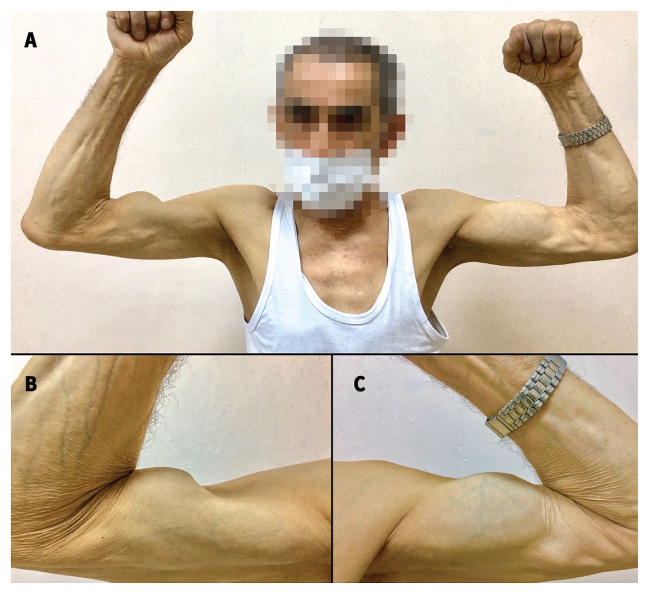 Popeye deformity” associated with proximal biceps tendon rupture